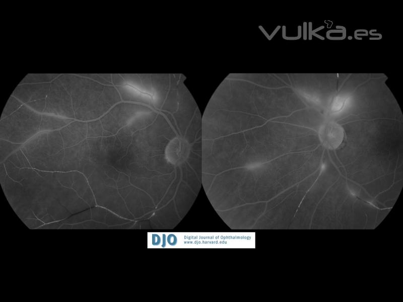 vasculitis lues