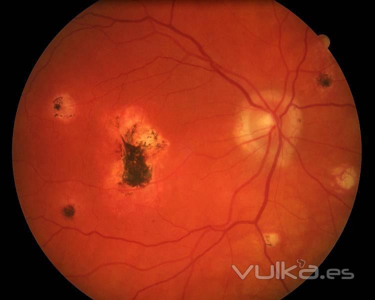 coroiditis multifocal