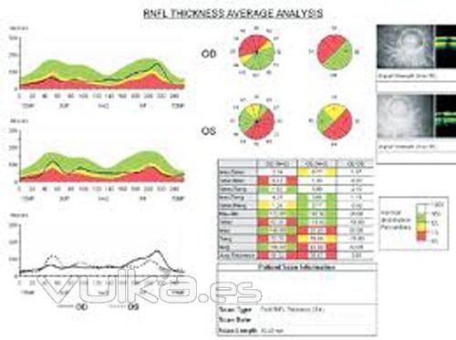 glaucoma con OCT