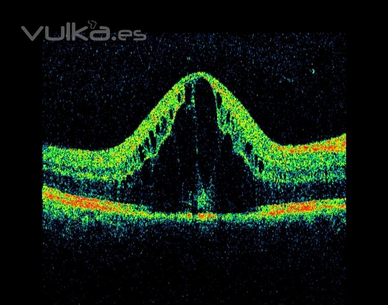 edema macular diabetico