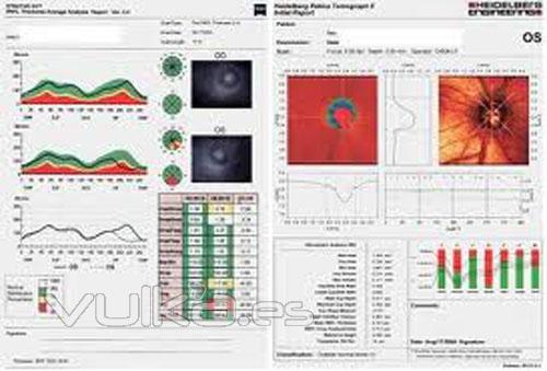 tomografia laser, diagnostico