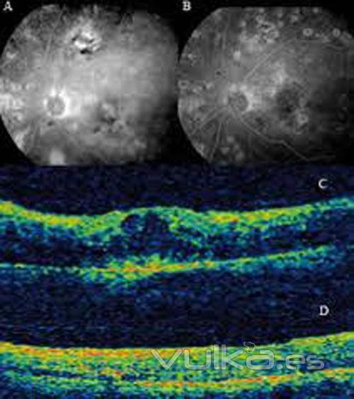 vitreolisis