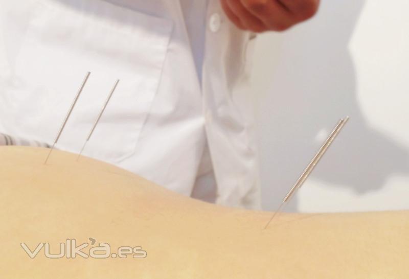 acupuntura (Fisioterapia y Masajes SANHE)