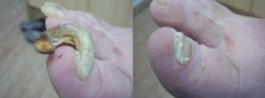 Onicogrifosis en 1º dedo de pie derecho, resultado tras fresar y cortar lamina afecta