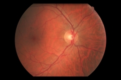 Rpt esclero-hipertensiva