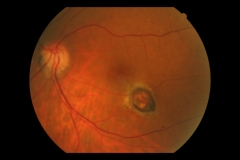 Toxoplasmosis parafoveal