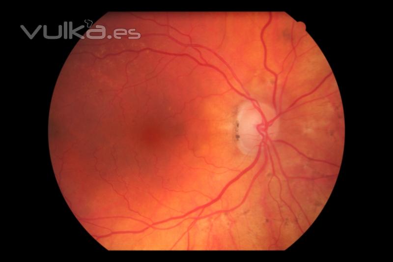 neuritis isq.