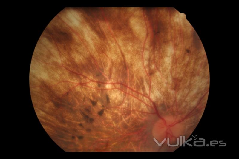 retinitis p.