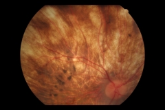 Retinitis p