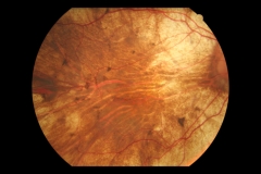 Retpigmentaria