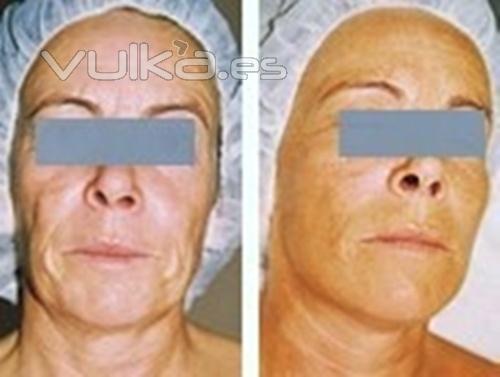 	 Tratamiento corrector de líneas y reafirmación facial (Inyector Electrónico exclusivo de Lamdors)