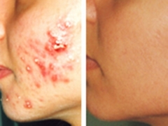 Tratamiento t.c.a. para pieles grasas con tendencia acnica.