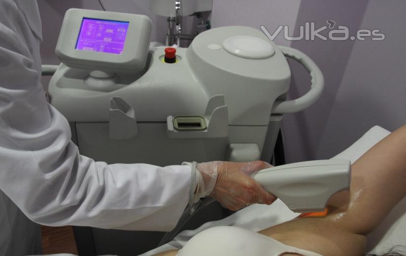 Sesin dermodepilacin axilas en Laser & Beauty