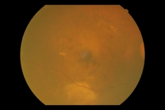 Dispers epr y embolia