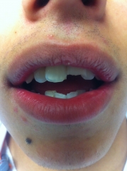 Estetica dental fractura de incisivos centrales
