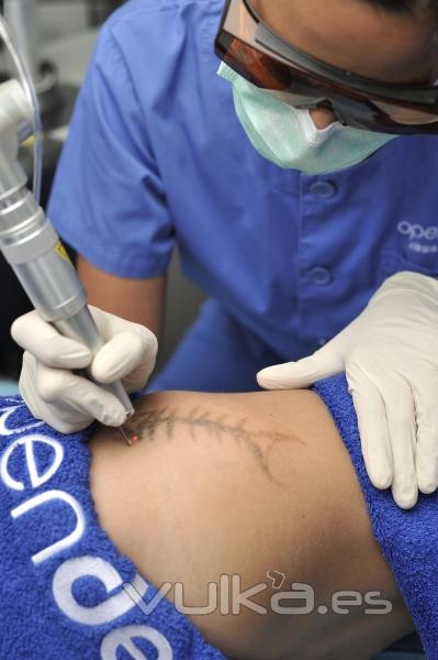 Eliminación tatuaje con láser Q-switched en Clínica Dermatológica Openderma, Murcia