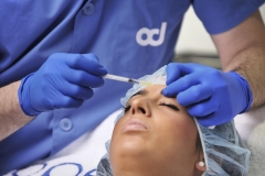 Botox estetico (vistabel, azzalure, bocouture) en clinica dermatologica openderma, murcia