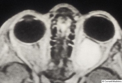 Glioma dre