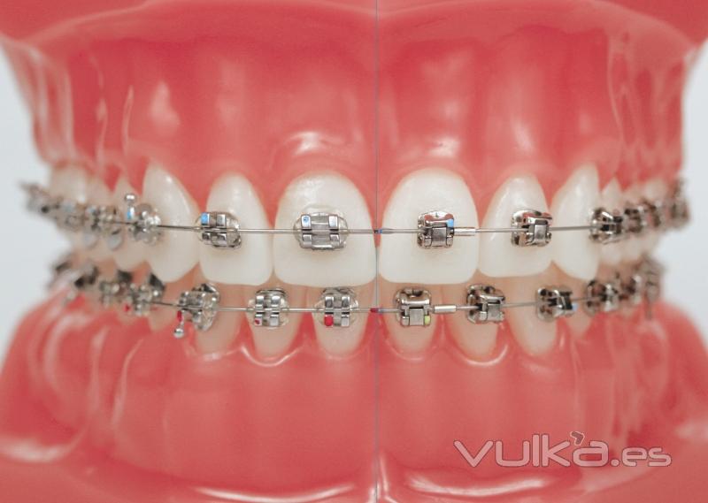Montaje tradicional de ortodoncia