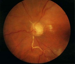 Arteritis wagener