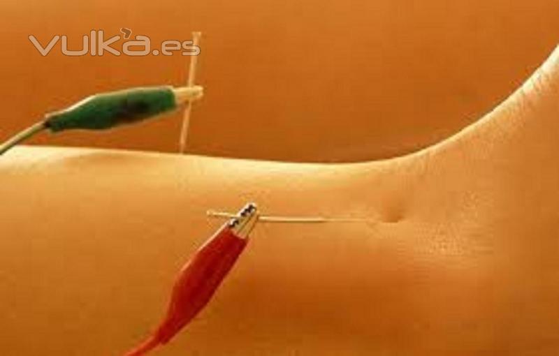 Electro-acupuntura para adelgazar