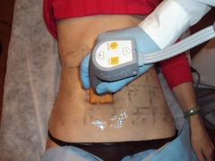 Thermage cpt system - radiofrecuencia corporal abdomen
