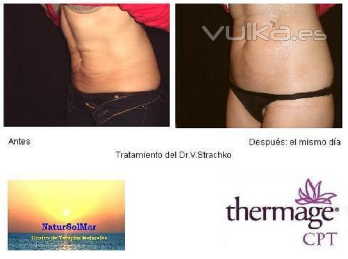 Thermage CPT System - Radiofrecuencia Corporal Abdomen