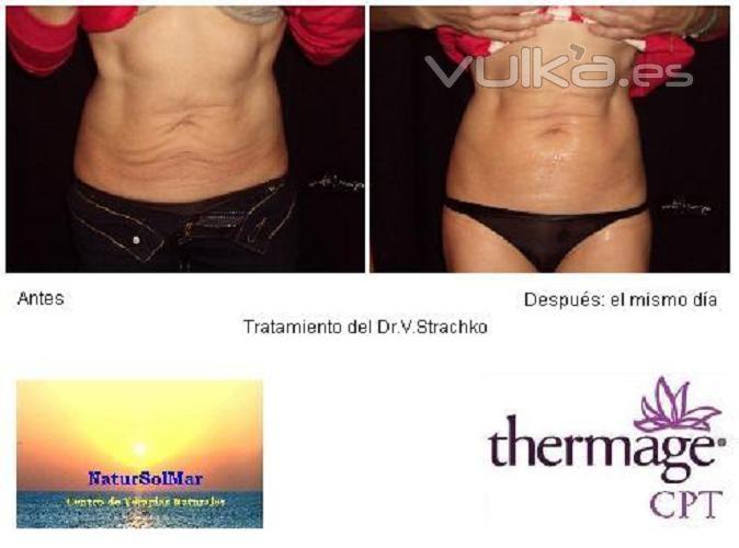 Thermage CPT System - Radiofrecuencia Corporal Abdomen