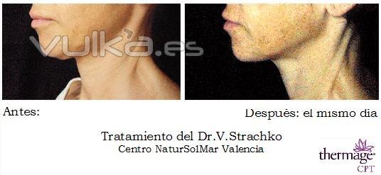 Thermage CPT-Rejuvenecimiento facial