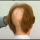 Protesis capilar a medida para todo tipo de Alopecia