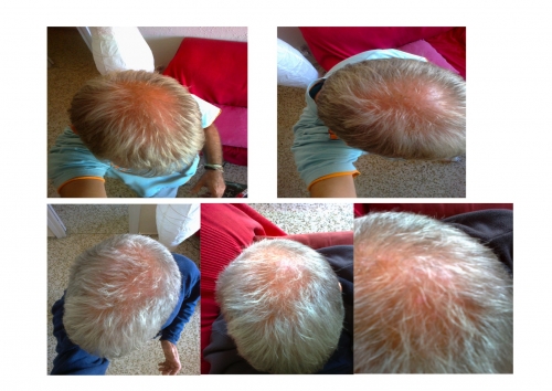 Evolucin tratamiento alopecia androgentica.