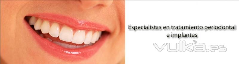 Dental Periodent, implante dental