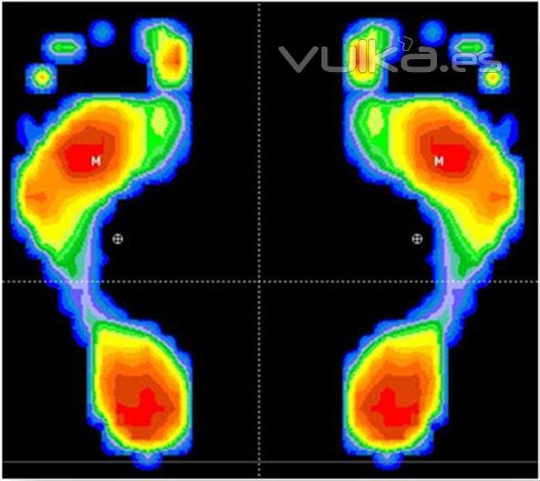 Análisis informatizado de la pisada y la marcha