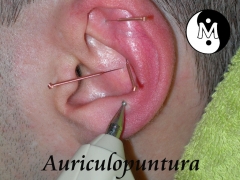 Auriculoterapia
