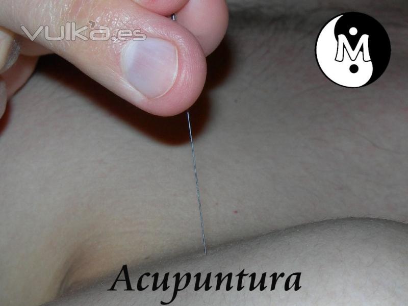 Acupuntura