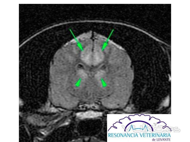 Edema citotxico secundario a convulsiones seguidas