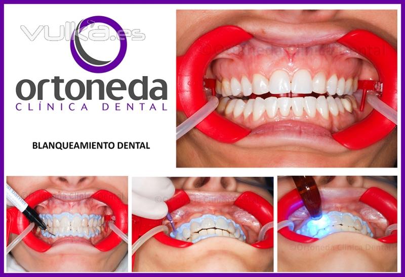 blanqueamiento dental