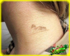 Eliminacion tatuaje en cuello con laser.