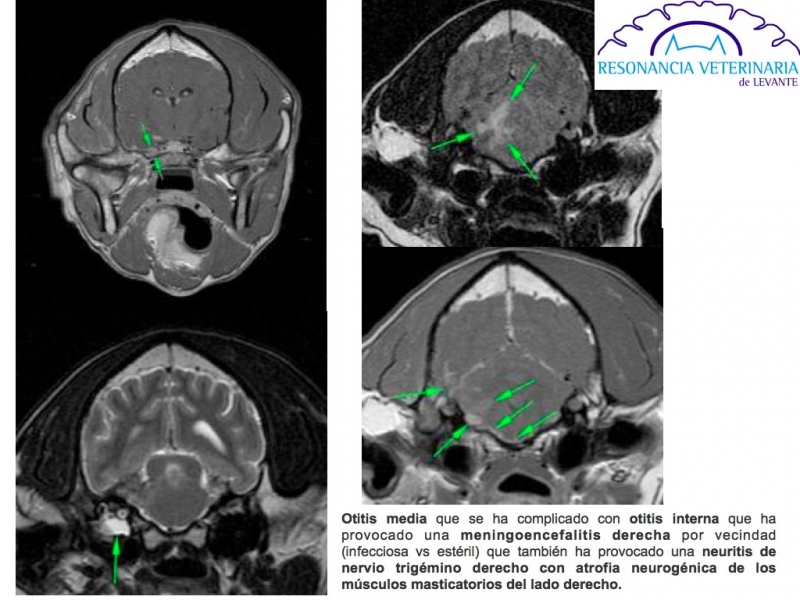 Otitis media-interna - Meningoencefalitis