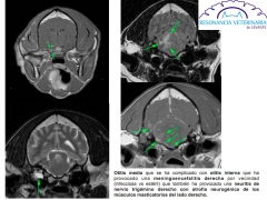 Otitis media-interna - meningoencefalitis