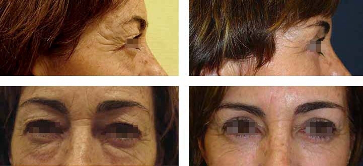 Blefaroplastia