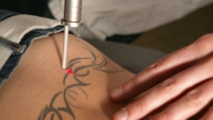 Foto 10 mdicos en Santa Cruz de Tenerife - Eliminacin de Tatuajes Tenerife - Tattoo-off