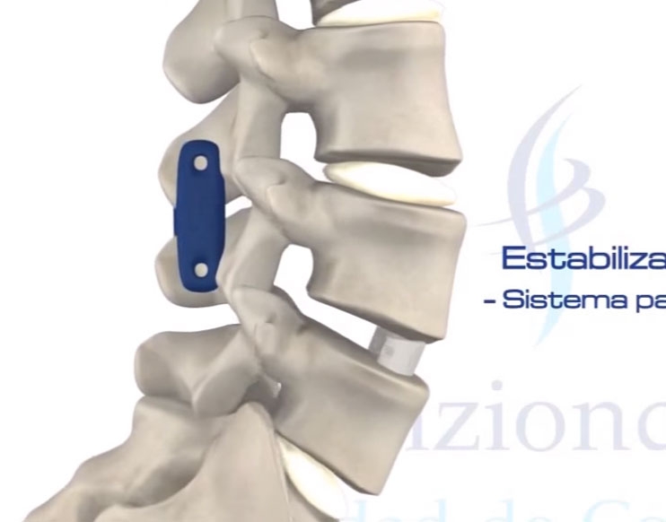 Alternativa a la artrodesis. Solucin de problemas de espalda complejos sin utilizar tornillos.