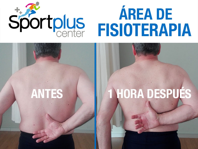 Tratamiento Tendinopata del Supraespinoso. Centro de FIsioterapia