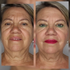 Tratamiento con juvederm y vistabel