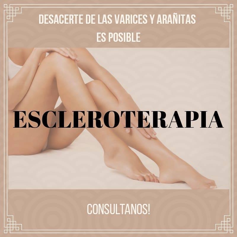 Tratamiento de varices con lser, espuma.Que no te engaen busca un especialista.