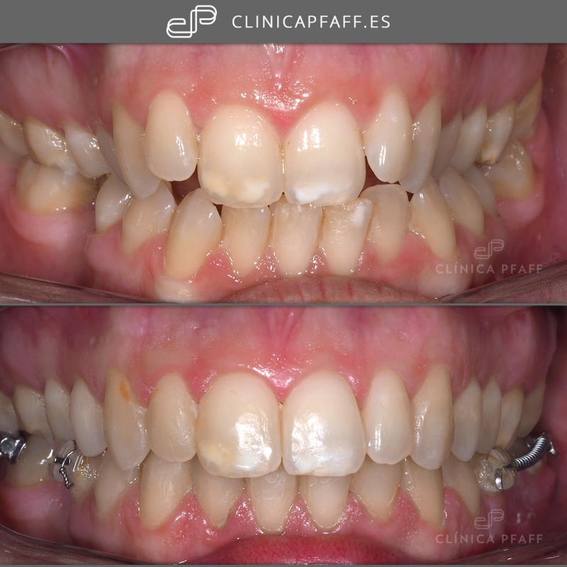 Caso antes y despus de ortodoncia