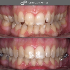 Caso antes y despues de ortodoncia
