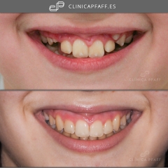 Caso antes y despues de ortodoncia infantil