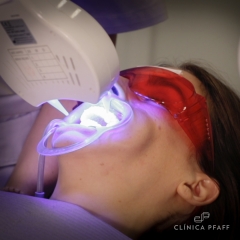 Blanqueamiento dental profesional en clínica Barcelona
